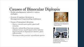 Binocular vs Monocular Diplopia [upl. by Alleunamme]