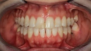 Invisalign Time Lapse [upl. by Asik]