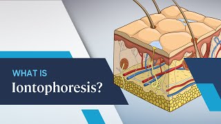 What is Iontophoresis [upl. by Clements]