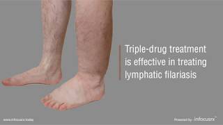 Tripledrug treatment is effective in treating lymphatic filariasis [upl. by Hays]