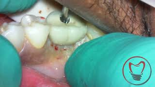 Removing a Broken Implant Screw [upl. by Becket]