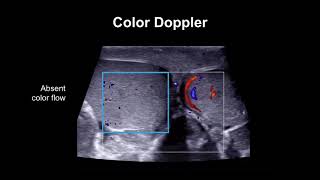 Diagnosing testicular torsion [upl. by Liddy983]