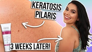 How Lactic Acid Works to Help Manage Dry Skin Associated with Keratosis Pilaris [upl. by Nimesay]