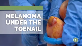 Melanoma UNDER the toenail [upl. by Lello]