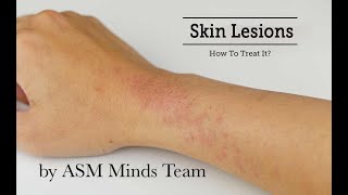 Skin lesions part 1Benign and Premalignant by ASM Minds Team [upl. by Ecyrb6]