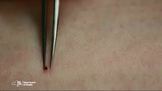 Proper Tick Removal [upl. by Khajeh]