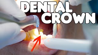 Dental Crown Procedure EXPLAINED [upl. by Marinna739]