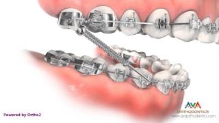 Orthodontic Treatment for Overjet Overbite  Forsus Appliance [upl. by Akcinehs740]