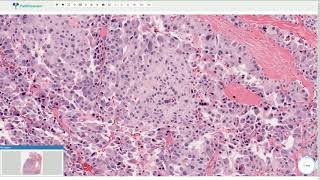 Medullary Carcinoma  Thyroid Gland Histopathology [upl. by Ordnajela]