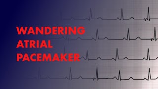 Wandering Atrial Pacemaker  EKG ECG Interpretation [upl. by Medovich]