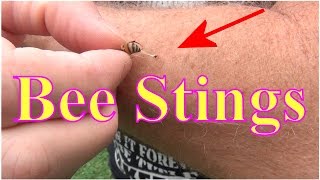 Beekeeping Bee Stings Ouch Stung By A Honey Bee Now What [upl. by Ycak]