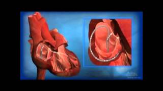 Ablation for AV Node Reentrant Tachycardia AVNRT [upl. by Ybrik]