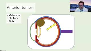 Brachytherapy for treating localised prostate cancer [upl. by Rimidalv]