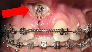 🔥Unexpected orthodontic impaction🔥 and OPEN BITE timelapse HOW BRACES WORK [upl. by Itsirhc]