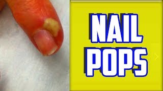 Top 4 Paronychia amp Nail Infections of All Time [upl. by Norling]