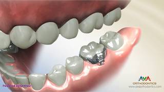 Orthodontic Band Placement on a Molar [upl. by Zertnom]