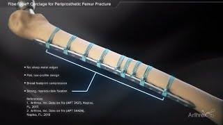 FiberTape® Cerclage for Periprosthetic Femur Fracture [upl. by Inna585]