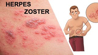 HERPES ZOSTER  O que Ã© Como cuidar Por Luiz Gameiro dermatologista [upl. by Marpet]