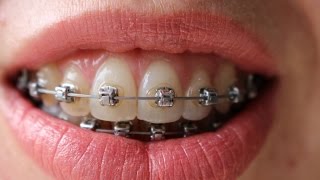 Braces time lapse  16 months [upl. by Keeley]