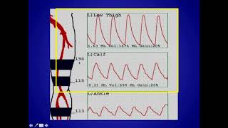 How To Ultrasound Guidance for Central Venous Access Part 1 Case Study [upl. by Atteram]