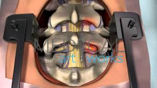 3D Medical Animation  Lumbar spine surgical procedure 2 level fusion of L4S1 [upl. by Fiore905]