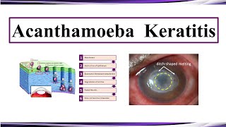 Acanthamoeba Keratitis [upl. by Adnil933]