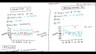 Conductive and Sensorineural Hearing Loss Deafness for USMLE [upl. by Adolpho]