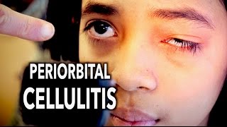 PERIORBITAL CELLULITIS Painful  Dr Paul [upl. by Nessie]