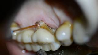 Periodontal Disease Management  Waterlase Laser Dentistry Desai [upl. by Holtorf]