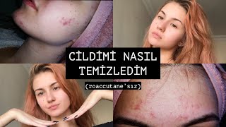 SİVİLCELERİMDEN NASIL KURTULDUM ✨ roaccutane’sız [upl. by Namrac536]