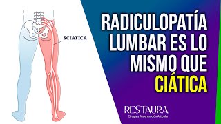 Radiculopatía lumbar ¿Es lo mismo que ciática [upl. by Donahoe461]