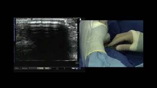 Ultrasound PICC insertion [upl. by Llenyaj]