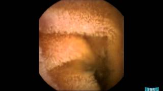 Inflammatory Lesions in the Small Bowel [upl. by Ainahs8]