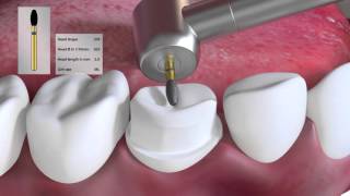 Crown preparation tutorial by Prof Brian Millar [upl. by Voss]