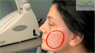 Acne Scar Removal in Los Angeles using TCA Cross Technique [upl. by Ruddie]