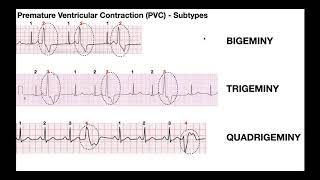 EKG Patterns  Premature Atrial amp Ventricular Contractions PACs amp PVCs [upl. by Chaiken557]