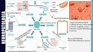 What is Lewy Body Disease [upl. by Ehrlich313]