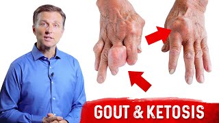 Gout amp Ketosis – Uric Acid Stones amp High Uric Acid On Keto – Dr Berg [upl. by Dopp]