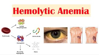 Hemolytic Anemia [upl. by Herculie]