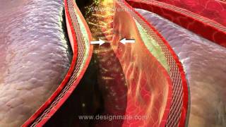 Assista a aula sobre Aterosclerose simulada na nova Lousa 3D Estereoscópico [upl. by Ive]