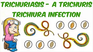 Trichuriasis  A Trichuris trichiura Infection [upl. by Comyns412]