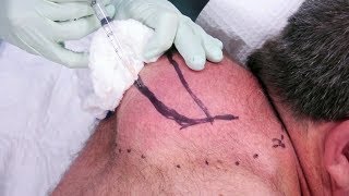 Lénorme boule de Paul  Docteur Pimple Popper [upl. by Lindsley]