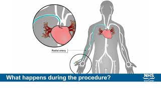 Coronary Angiogram Procedure [upl. by Ahseyk]