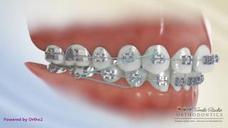 Elastics  Class II Triangle 3 to 46  Orthodontic Treatment [upl. by Asselam30]