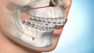 Chirurgie Maxillofaciale et orthodontie [upl. by Balcer]