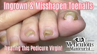 How To Transformation Squeezed Ingrown Toenail Pedicure [upl. by Airdnaxela]