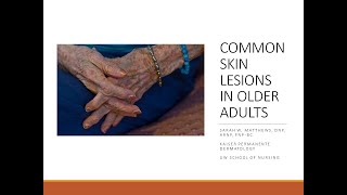 Common Skin Lesions in Older Adults [upl. by Itsirc]