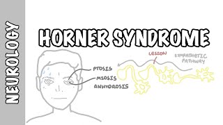 Horners syndrome  Symptoms and causes [upl. by Thin]