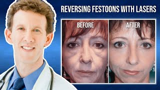 Laser Skin Resurfacing for Festoons with Dr Adam Scheiner [upl. by Goldia]