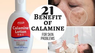 CALAMINE lotion  Lacto calamine lotion uses in detail side effects [upl. by Orji271]